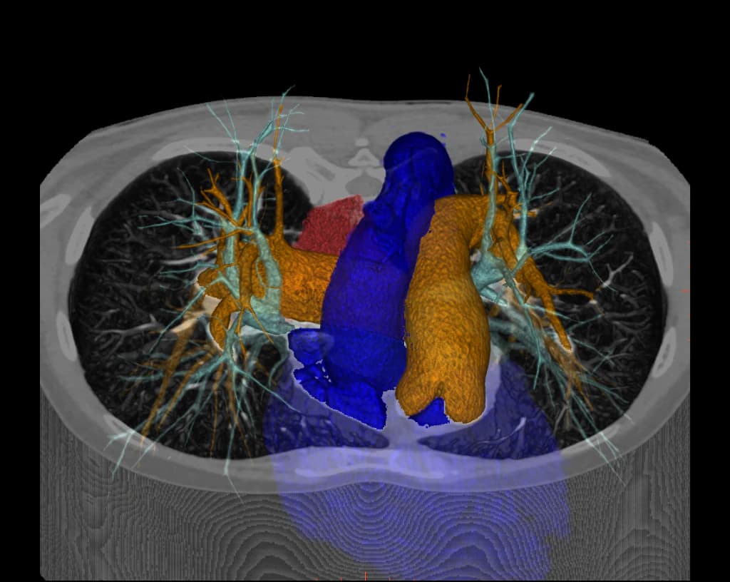 CT chest post-processing visualization showing thoracic anatomy and vascular structures
