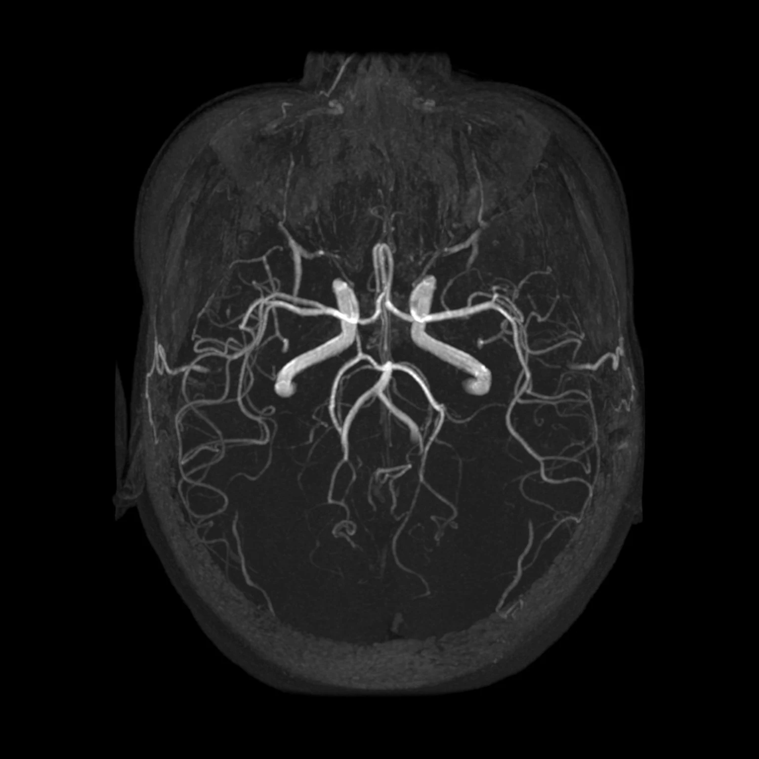 Monochrome MR angiography maximum-intensity-projection vascular reconstruction