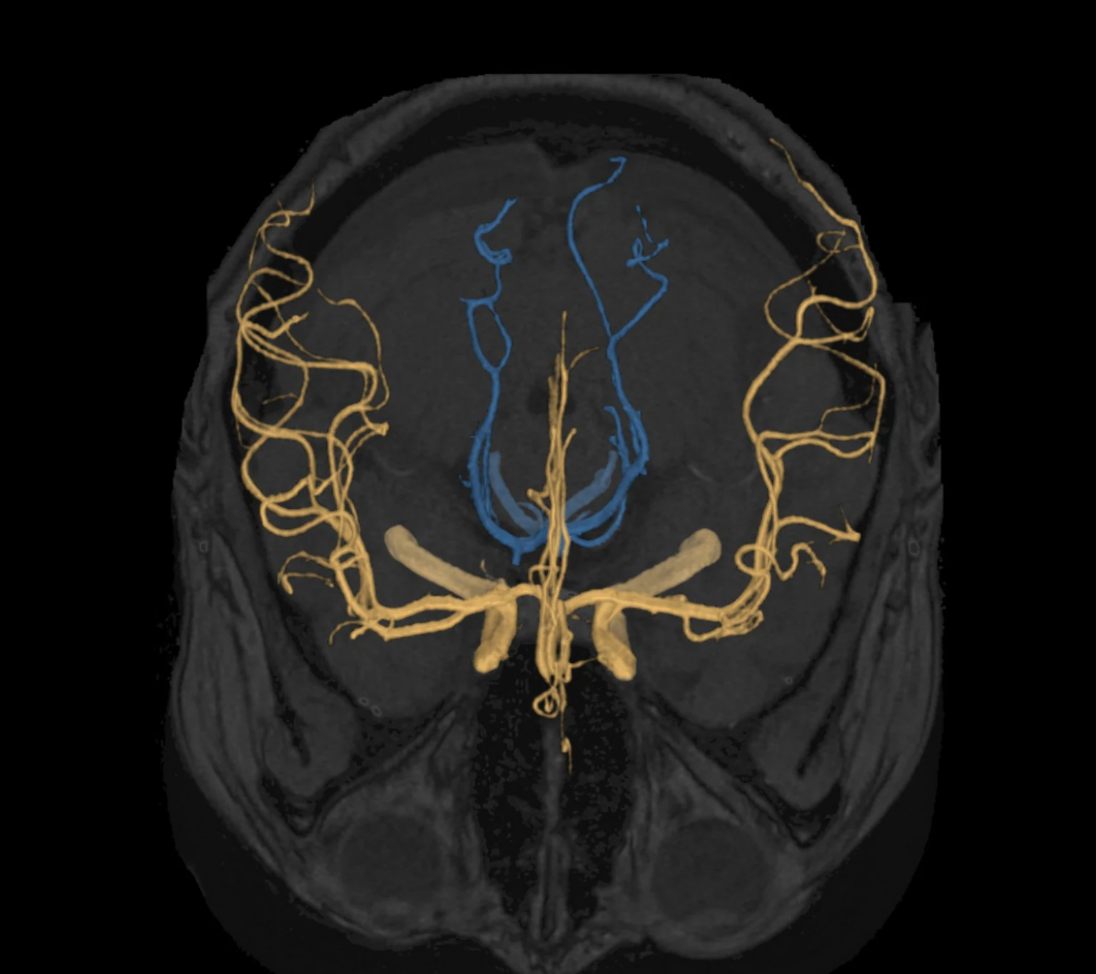 MR angiography visualization of intracranial vascular structures