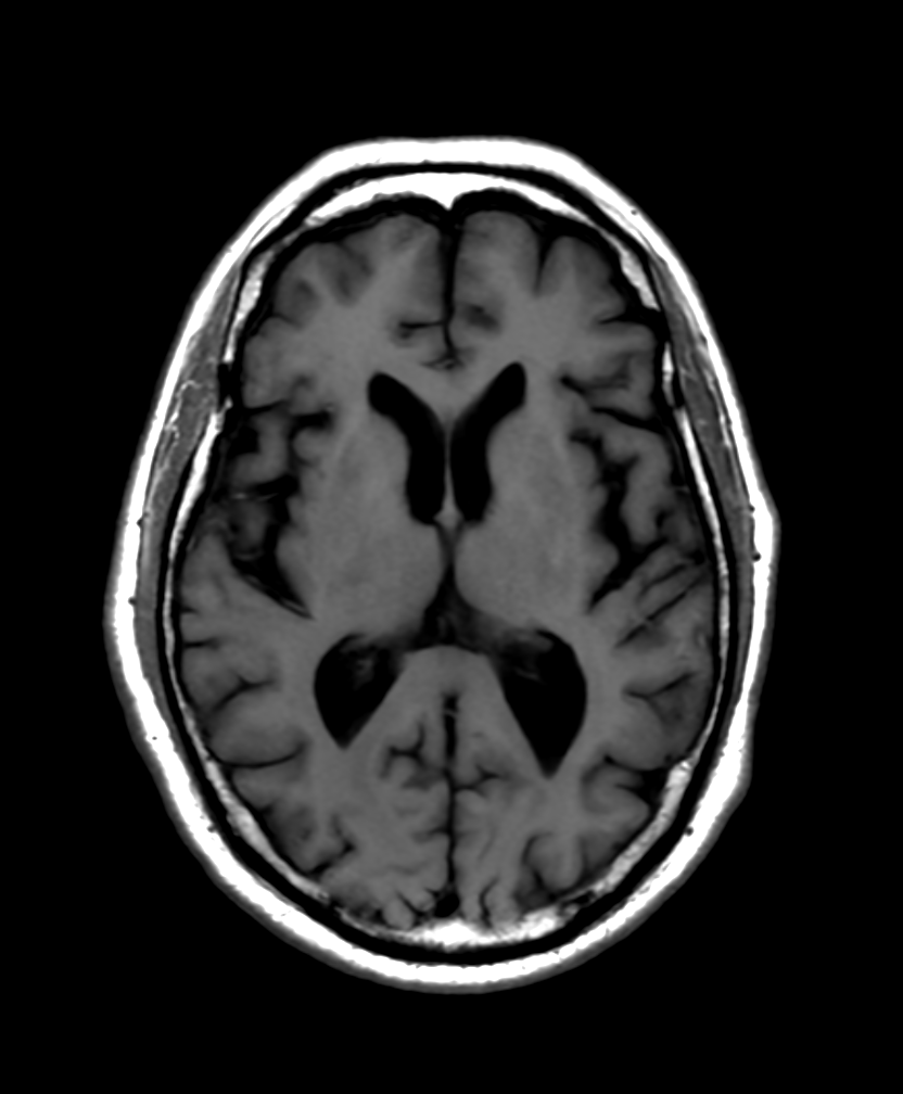 Axial T1-weighted MRI brain image for imaging education